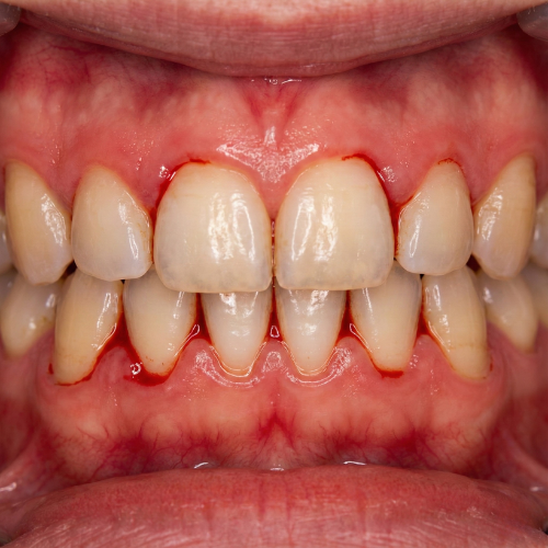 gum bleeding thanisandra RT Nagar